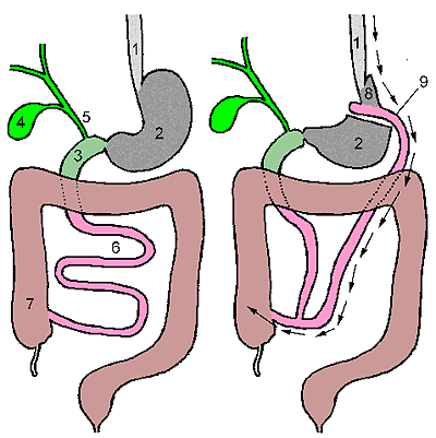 Шунтирование желудка - схема желудочного шунтирования